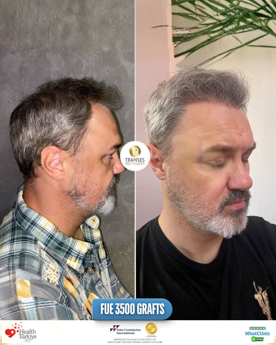 transeshair's tweet photo. This hair transplant operation was performed at Istanbul Tema Hospital BHT Clinic.
15 years of experience with a 4.9 ⭐ WhatClinic rating.
FUE • DHI • HYBRID • PRP
Natural results, professional care.

#YourJourneyYourTransformation
#TransesHairTransplant
#FUE #DHI #PRP https://t.co/tfqG5oqAbt