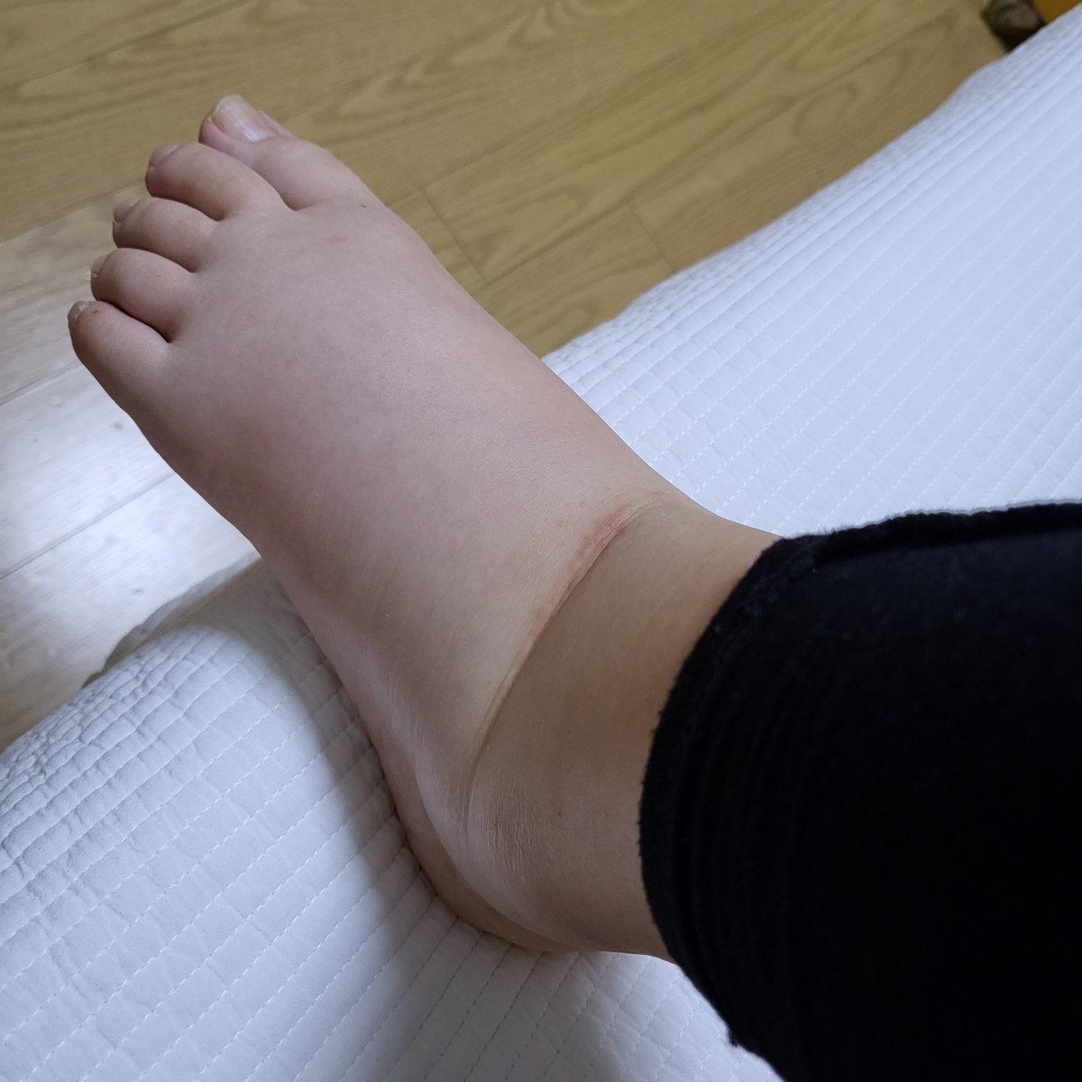 살이 문제가 아니라... 부종으로 몸이 아프다고요 이 사람들아.... 살려고 받는 마사지라고오..... (화낼 기운도 없음) 사진 속 산모의 몸무게 52kg 이며 출산 후 7일째 날이다