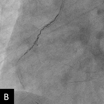 gbiondizoccai's tweet photo. Beware: the guidewire twisting method to retrieve dislodged stent may lead to dissection and acute coronary occlusion! https://t.co/9n9yC0UhGD @ccijournal https://t.co/EWYQdFhHxz