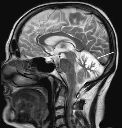 spinacademics's tweet photo. This week's SPIN-POV: A child with recurrent ataxia, cerebellar signs and atrophy needs CACNA1A sequencing — the same gene causes episodic ataxia type 2, hemiplegic migraine, and SCA6. EA2 is uniquely treatable; acetazolamide can stop the attacks. https://t.co/sstIbmNiv4