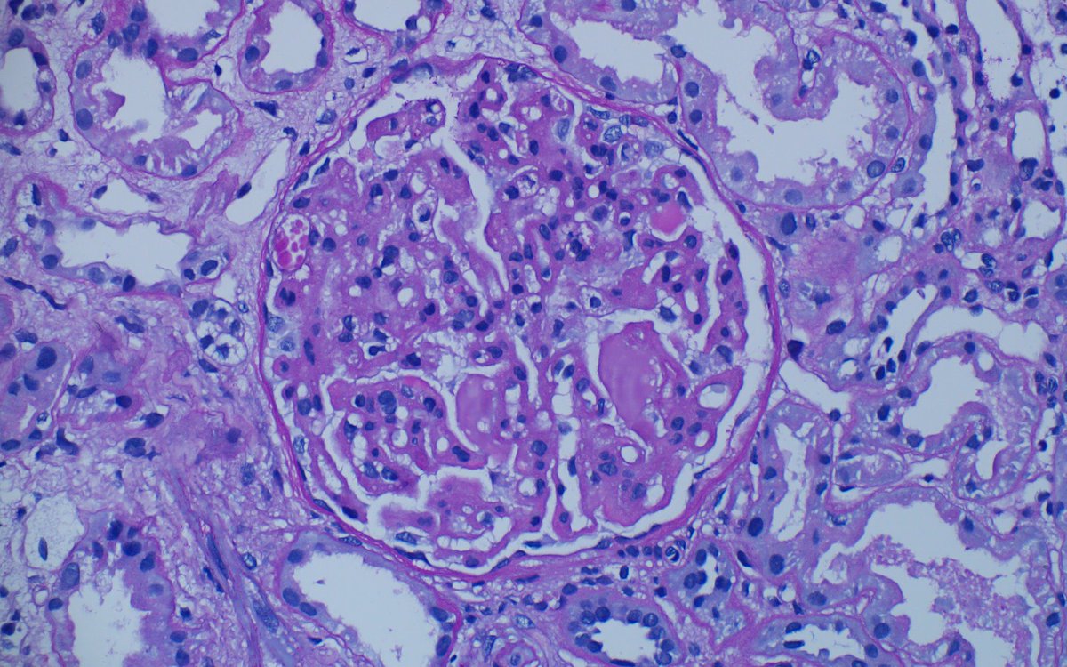 Zhou1217001's tweet photo. #renalpath young F, NS, normal SCr. The material filling the microaneurysms with double contours was seen in glomeruli. Did not receive any anti-VEGF therapy. Gene test showed MMACHC mutation. https://t.co/qmP9DJlDR9