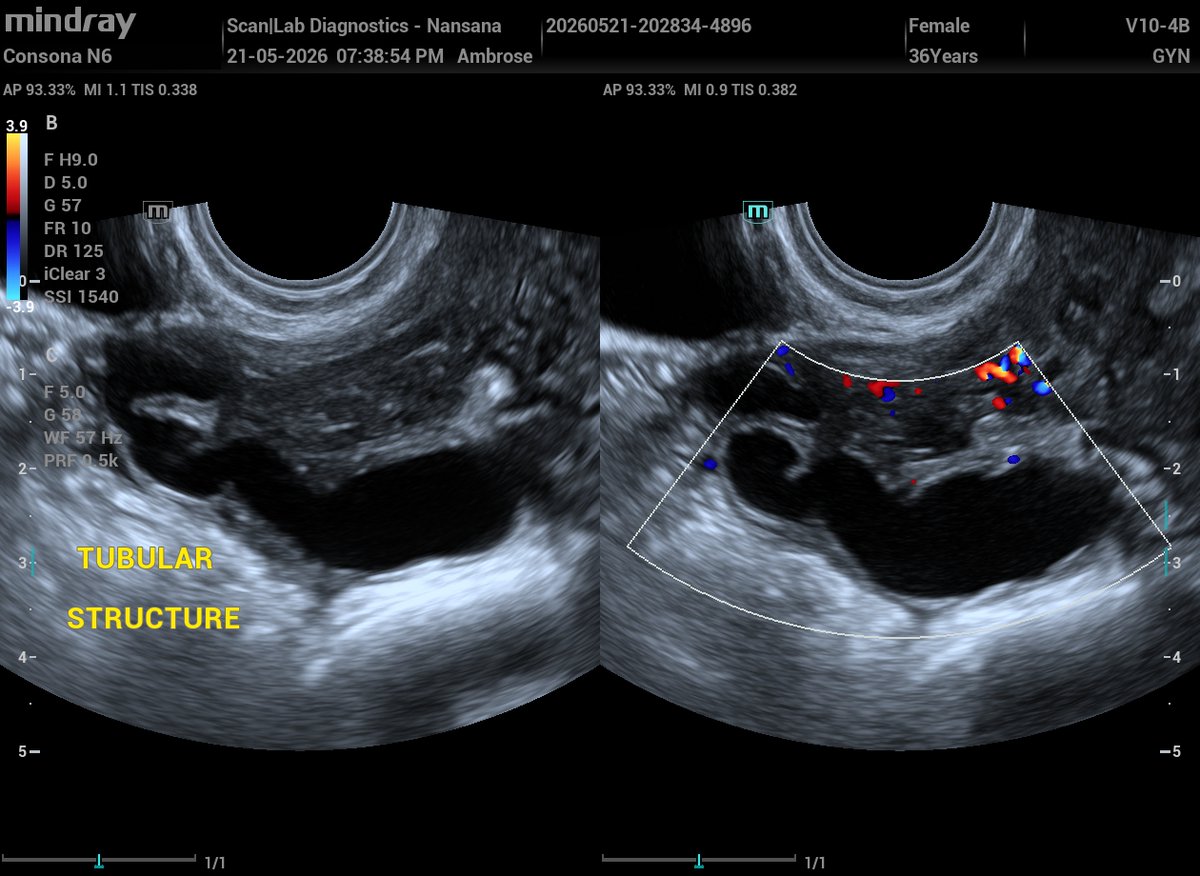 ambrose074's tweet photo. A 36‑yr‑old female with secondary infertility and h/o laparoscopic surgery in January this year, for right hydrosalpinx and left pyosalpinx.
TVS was performed today and here are the findings: 
Normal uterus in size, shape and echotexture,
Normal trilaminar endometrium of proliferative phase,
A right adnexa avascular tubular structure adjacent to the ovary,
a small anechoic cystic mass with posterior acoustic enhancement in the left adnexa adjacent to the ovary
Normal ovaries in volume.
So;
What is the likely nature of the right adnexal tubular structure?
What are the differentials for the left anechoic mass in this postoperative context
Sonograms👇👇👇
