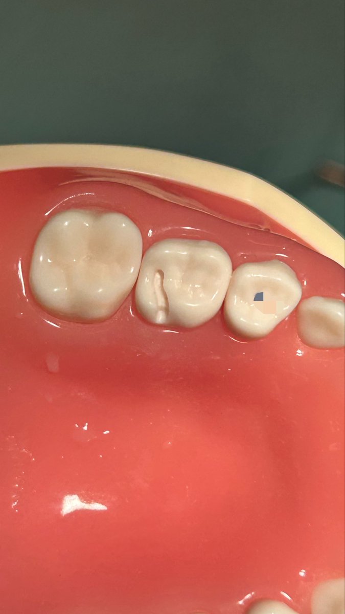 myn_dn's tweet photo. Class II prep on a primary
 Upper molars https://t.co/hbH8cqqbig