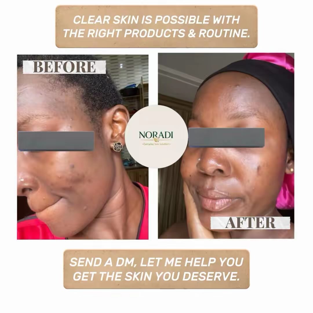 Noradi | I DON’T JUST SELL PRODUCTS. I FIX SKIN. ✨ tweet media