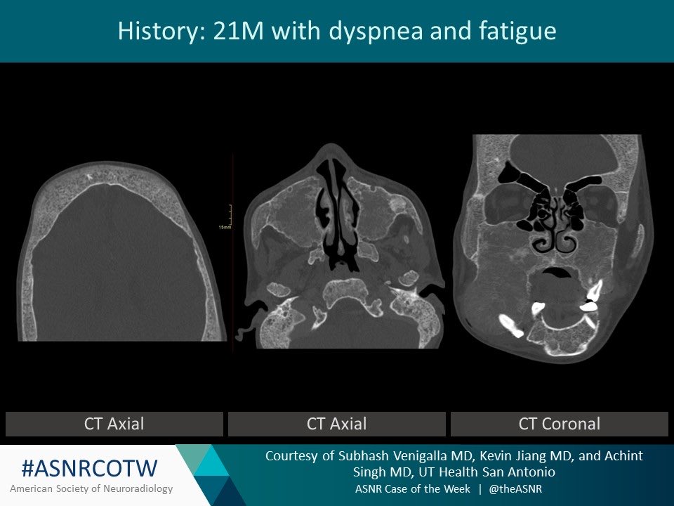 TheASNR's tweet photo. ASNR COTW # 296

Hx: 21M with dyspnea and fatigue

NO SPOILERS! Give hints in the form of GIFs or answer poll. Answer in 24 hours.  

#neuro #neurorad #radres #FOAMed #FOAMrad #medtwitter #ASNRCOTW https://t.co/5JPgydwaqs