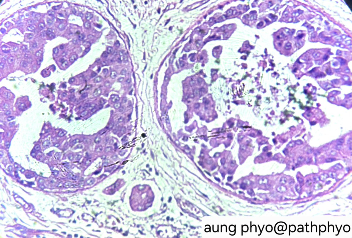 pathphyo's tweet photo. A focus of micropapillary DCIS characterized by ducts expanded by epithelial proliferation displaying micropapillary architecture. There is background invasive micropapillary carcinoma.
#pathology #breastpath #DCIS https://t.co/RBsL53fy3l