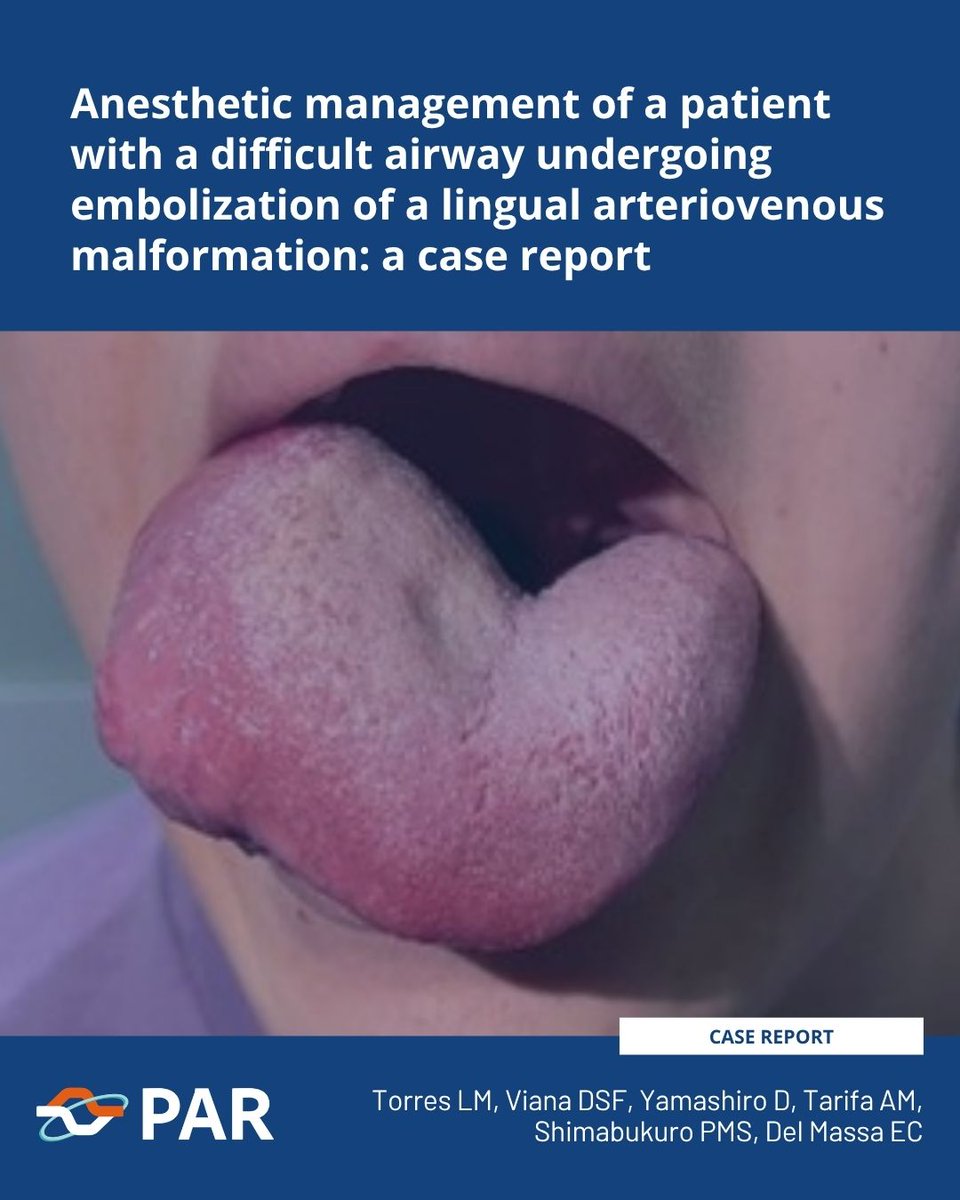 journal_PAR's tweet photo. AVMs of the tongue are rare vascular anomalies that may pose significant anesthetic challenges. This case of a 17-year-old patient with a large lingual AVM undergoing endovascular embolization highlights the importance of preoperative assessment and airway management strategies. https://t.co/ZfGpiw8EZL