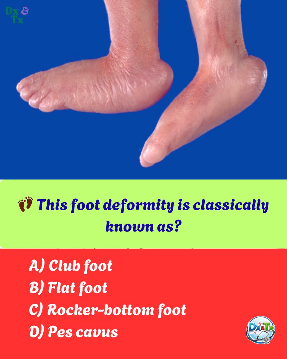 DrMedica_13's tweet photo. 👣 This foot deformity is classically known as?

A) Club foot  
B) Flat foot  
C) Rocker-bottom foot  
D) Pes cavus  

💡 Hint: Commonly associated with chromosomal abnormalities.

#DrMedica #MedicalQuiz #Orthopedics #ClinicalSigns #MedEd #NEETPG #USMLE https://t.co/UmGpICGHOk