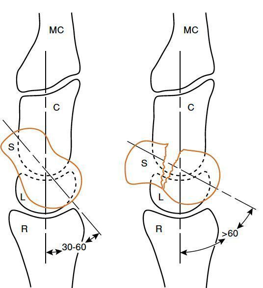 MoAImam's tweet photo. A, Normal scapholunate angle (SL) is 30 to 60 degrees. A normal capitolunate angle (CL) is (0±15) degrees. B, Displaced scaphoid fracture leads to dorsal intercalated segmental
instability (SL angle >60 degrees) through internal angulation and humpback deformity. C, Capitate; MC, metacarpal; L, lunate; R, radius; S, scaphoid.