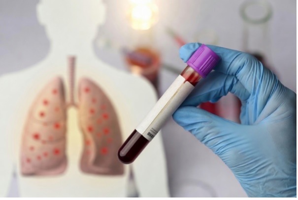 UCSFAging's tweet photo. Proud of BARI’s Dean Sheppard on his new Thorax paper! Circulating CTHRC1 levels (a marker of pathological fibroblasts) are elevated in IPF and strongly predict disease severity, faster progression, and reduced transplant-free survival. Promising new biomarker! https://t.co/YPJPe4b9H0