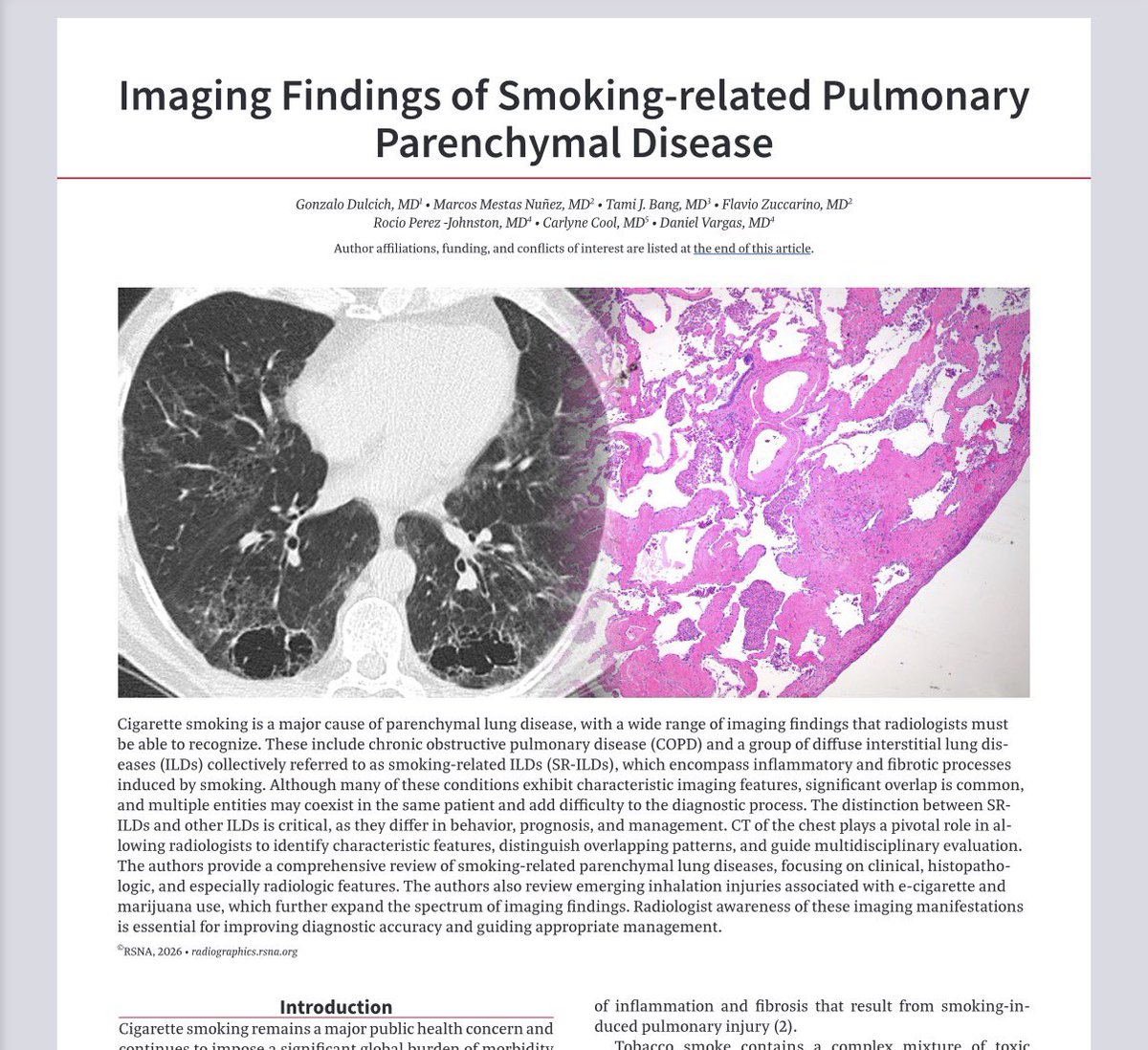 DanielVargasMD's tweet photo. Hot off the press! 

Our paper on 🚬 Smoking-related Pulmonary Parenchymal Disease 🩻 in @RadioGraphics 

https://t.co/o2xwMTudeI

Another wonderful collaboration w @DulcichGonzalo @marcosmestas and others!

@RSNA @atscommunity @thoracicrad @CURadiology @CUAnschutz https://t.co/EbmeIl9C2k