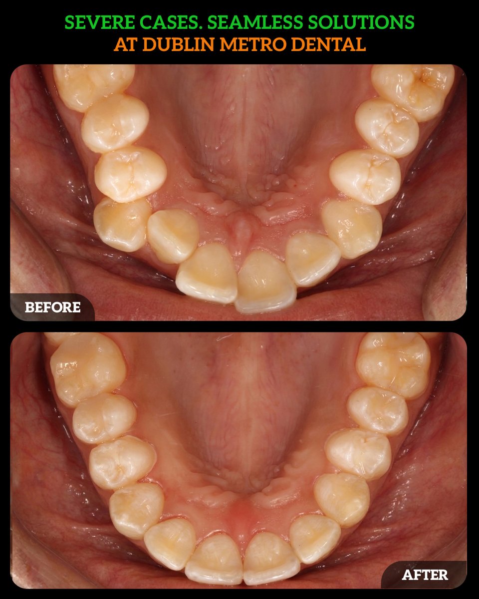 DMDGroup's tweet photo. Michaela’s journey is a reminder that orthodontic treatment isn’t just about teeth — it’s about confidence, self-esteem, and feeling comfortable in your own smile.
📞 (614) MY-SMILE
🌐 https://t.co/cTIepI3ioF
#InvisalignTeen #TeenSmile #SmileConfidence #CrookedTeeth #GapClosure https://t.co/ME5u12mxLH