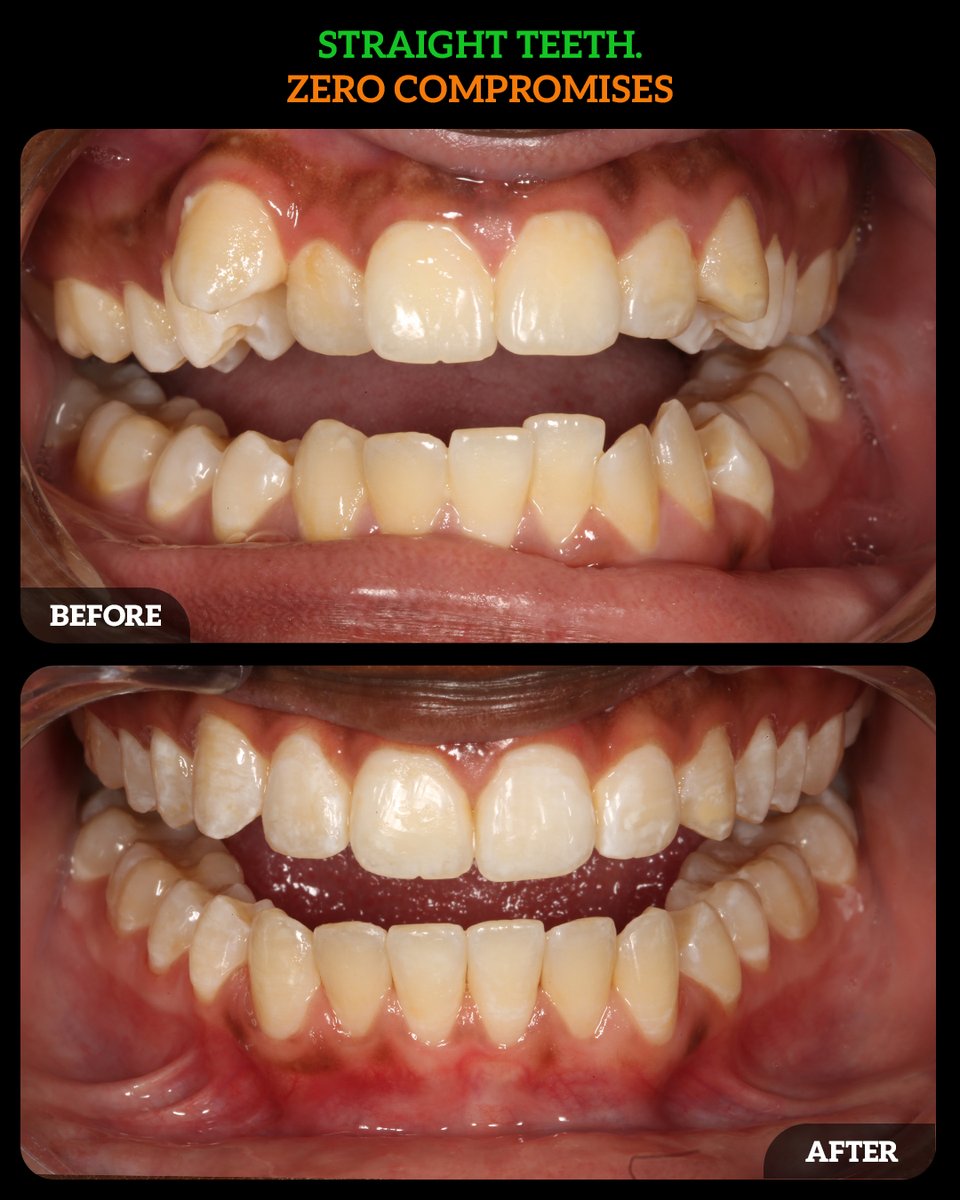 DMDGroup's tweet photo. Michaela’s journey is a reminder that orthodontic treatment isn’t just about teeth — it’s about confidence, self-esteem, and feeling comfortable in your own smile.
📞 (614) MY-SMILE
🌐 https://t.co/cTIepI3ioF
#InvisalignTeen #TeenSmile #SmileConfidence #CrookedTeeth #GapClosure https://t.co/ME5u12mxLH