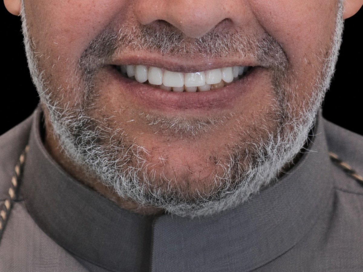 OF9Y9's tweet photo. من الحالات اللي تذكّرك ان طب الأسنان مو بس علاج… بل استعادة راحة وثقة وجودة حياة.

اليوم وبتوفيق من الله اكملت أنا وزميلي د. نواف الغيلان @NawafAlghailan رحلة علاج أحد المراجعين بتركيب طقم الأسنان، وبعد معاناة طويلة مع الأكل والكلام والثقة بالنفس، كانت ابتسامته بعد التسليم أكبر مكافأة ❤️