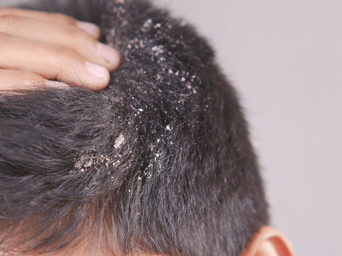 Ninja__Wisdom's tweet photo. DANDRUFF - An inflammatory/fungal sign that your underlying health is deteriorating.

Let's go through exactly how it develops, what it means for your health, and some ways to help. (🧵1/13) https://t.co/z8PVyXO6HU