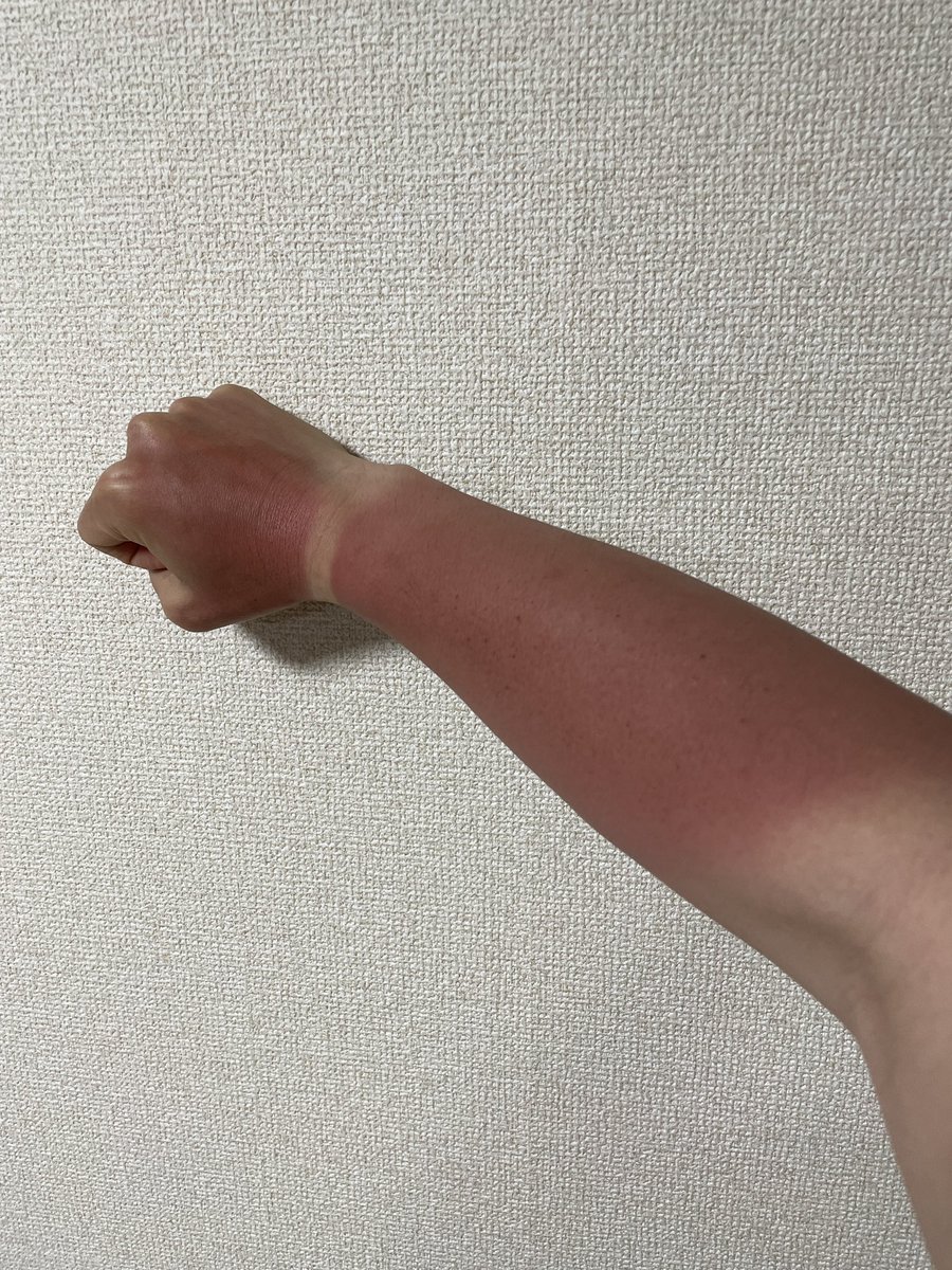 anme_007's tweet photo. 半年ぶりに管理釣りしたら日焼けしすぎた…めちゃくちゃ痛い🥲 https://t.co/VVx3jvcLK8