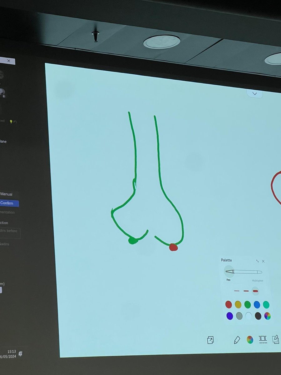 KardiologieHH's tweet photo. @monaltiren @BernardBruyne @JEscaned @OlgaTolevaMD @ColinBerryMD @ColletCarlos @PCRonline #EuroPCR #DrawingMasterclass
Only @kiadeb87 at #EuroPCR 2024 was slightly more Picasso-esque ๐จโฌ๏ธ https://t.co/9N7mkvvIlN