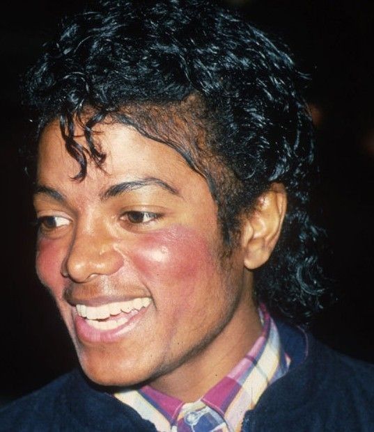 mjfriends_'s tweet photo. Gente só uma correção importante: a autópsia confirmou oficialmente o vitiligo, mas não citou o lúpus. Porém, o diagnóstico de lúpus discoide já havia sido confirmado anteriormente por médicos e pessoas próximas ao Michael.

O lúpus discoide é uma doença autoimune que afeta principalmente a pele e causa extrema sensibilidade ao sol, manchas, inflamações, lesões na pele e até queda de cabelo. Por isso Michael evitava tanto exposição solar, aparecia frequentemente com guarda-chuvas e usava maquiagem e pigmentação cosmética.

Além disso, a combinação entre vitiligo, lúpus, tratamentos dermatológicos, perda de peso e envelhecimento afetou bastante a aparência dele ao longo dos anos. Inclusive, o lúpus também pode comprometer a região nasal e a pele do rosto, o que ajuda a explicar parte das mudanças físicas que as pessoas resumem apenas como “plástica”.