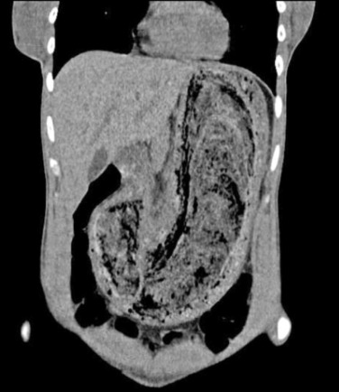 RevMedInterne's tweet photo. 📷Image
Quel est votre diagnostic devant cette coupe scannographique chez une patiente de 19 ans avec asthénie, nausées post-prandiales et perte pondérale associées à une anémie microcytaire et une hypoalbuminémie ?

La réponse : https://t.co/Z8lzgfmbs4 https://t.co/C5LdTlSDOI