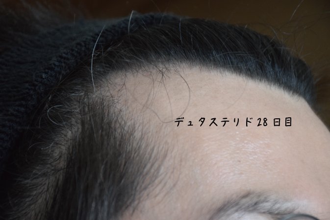 イクタ(39歳) | 元つむじハゲ・現在もM字ハゲ対策中 tweet media
