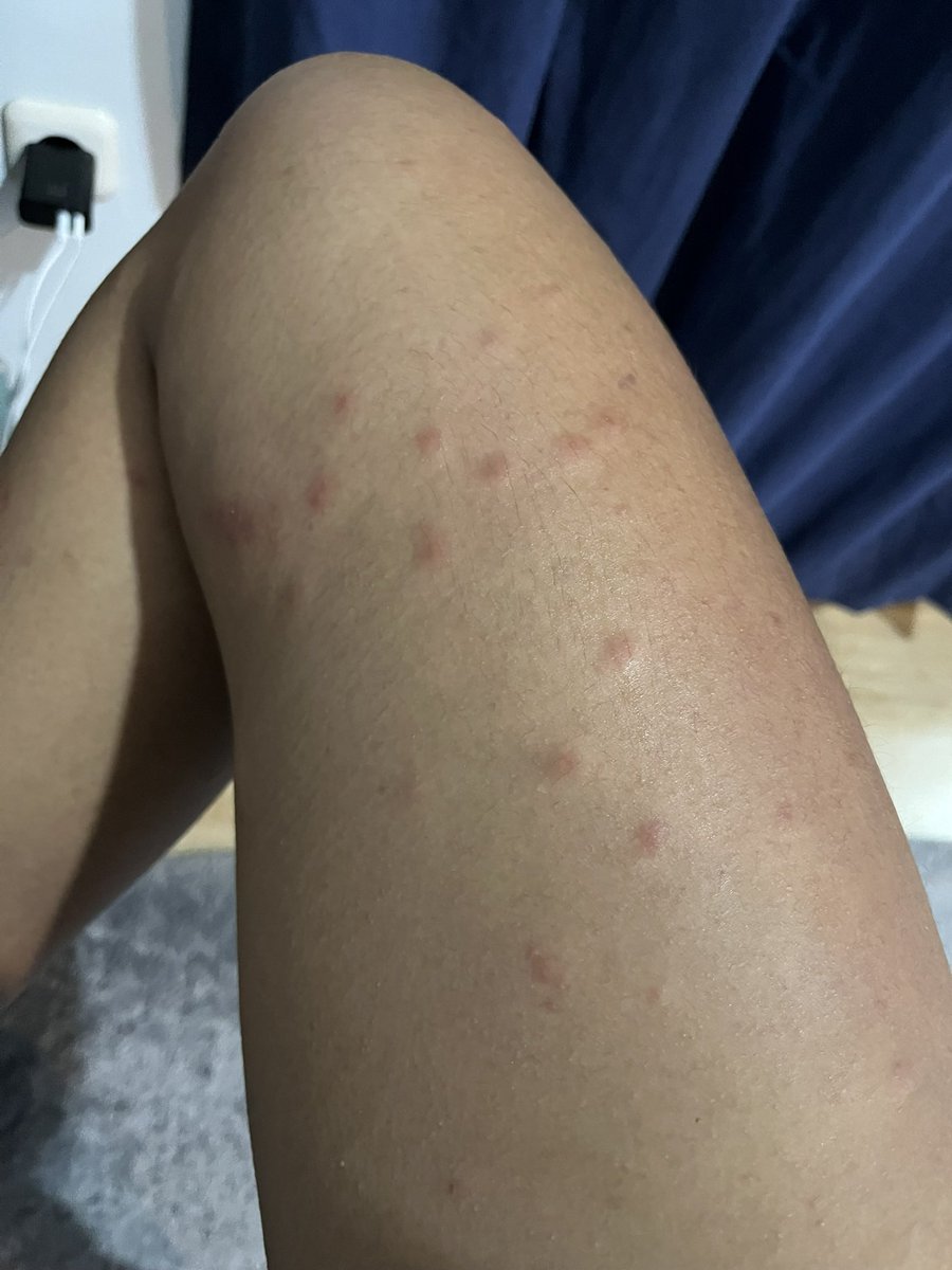 kalullaf's tweet photo. @diarybyraa Kayanya kena larva hewan laut. Nih aq jg tp aku tambah parah Krn sunburn juga. Minum obat alergi, olesin roundlab yg buat soothing gel (biar g panas), sama olesin aveeno yg dermexa (biar g membekas bgt). Jgn digaruk nnt malah nyebar https://t.co/iK3l00LBUW