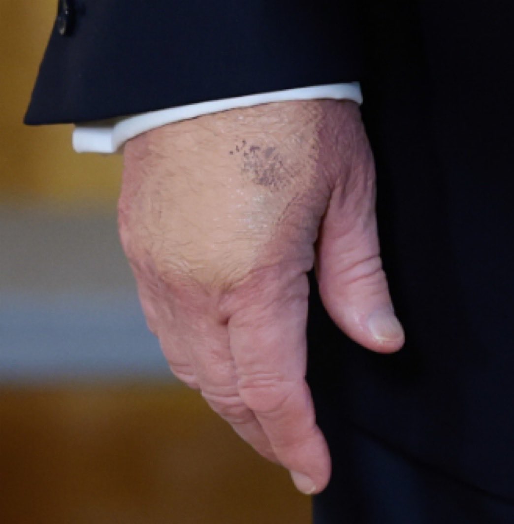 JohnHKeenan's tweet photo. @WhiteHouse Everything costs more. Groceries, gas, housing. The Trump Effect Sucks.
Also, what’s up with @POTUS’s hands? Is he getting treatments for something that cause the bruising? The President is 79, would be nice to see some medical reports.
#TrumpEffect #TrumpHands #MiracleEar https://t.co/tOyAxiUpsP