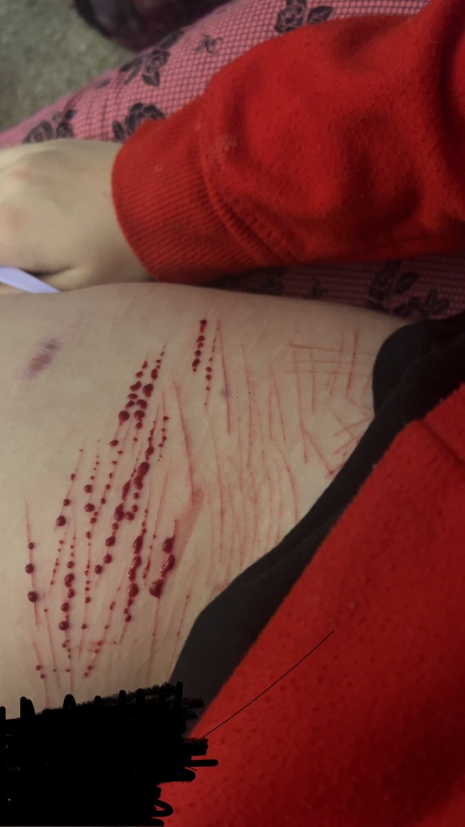 Hellokittylovrl's tweet photo. More yummy cat scratches #shedtwt #shtwt #shtなりきりさんがrtしてくれてそれを見たshtなりきりさんがきっとフォローしてくれる #slittwt #edtwt #anatwt
#miatwt #wItwt #eatingdisorder #skinny
#fat https://t.co/y8ign5XRM9