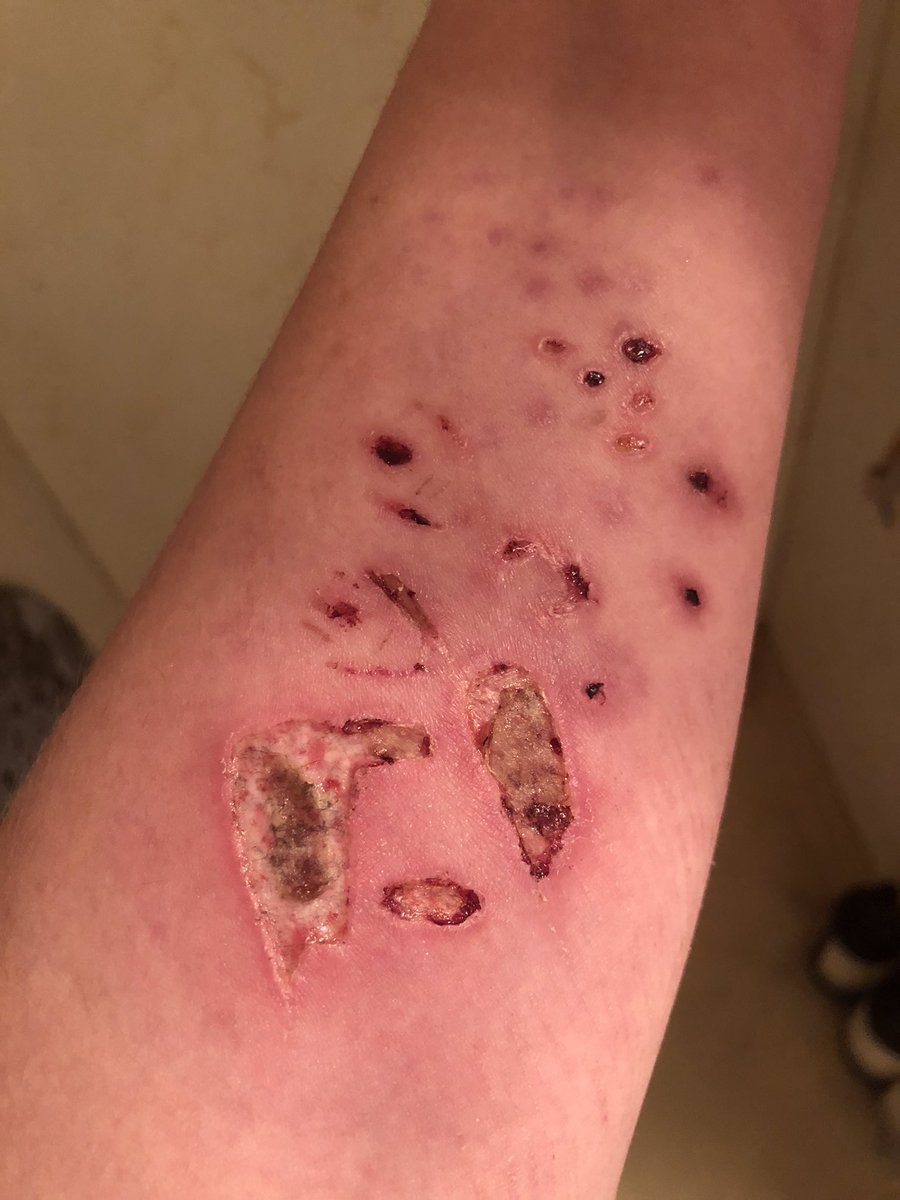 Bird08889112925's tweet photo. #burntwt burn update cause I was picking at my #scabs last night
(Surprise, surprise lol)
#sh https://t.co/tXNEFRhELC