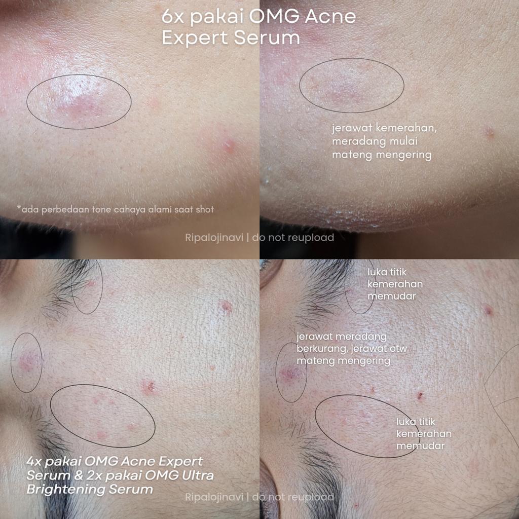 Ripalojinavi's tweet photo. Hasil pemakaian serum OMG yang acne sama Brightening, lumayan bgt walau harganya seharga Cetaim, kwkw https://t.co/Ra1scEuX9m