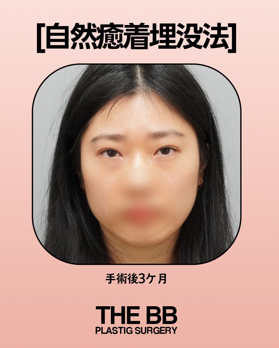 TheBBjp's tweet photo. 何度も取れてしまう二重や、なんとなく眠たそうに見える目元でお悩みの方は必見です。

しっかりとした二重の癒着で取れにくく、
お顔に合わせた黄金比ラインで、くっきりとした華やかな目元へと導きます。

ぜひ、ザビビ整形外科の自然癒着埋没法のビフォーアフターをご覧ください。

詳しいご相談はお気軽にお問い合わせください
02-6925-1999
ソウル特別市江南区江南大路402 時計塔ビル8階
LINE | @764qpbvm

※ 施術・手術の効果および回復の経過には個人差がございます。
※ 施術・手術の可否や詳細は、専門医の診察およびカウンセリングにより決定されます。
※ 本コンテンツは施術・手術への理解を深めていただくための情報提供を目的としており、
特定の効果を保証したり、無理に施術・手術を勧めるものではございません。
※ カウンセリングからアフターケアまで、通訳士が同行いたしますので、安心してお越しください。