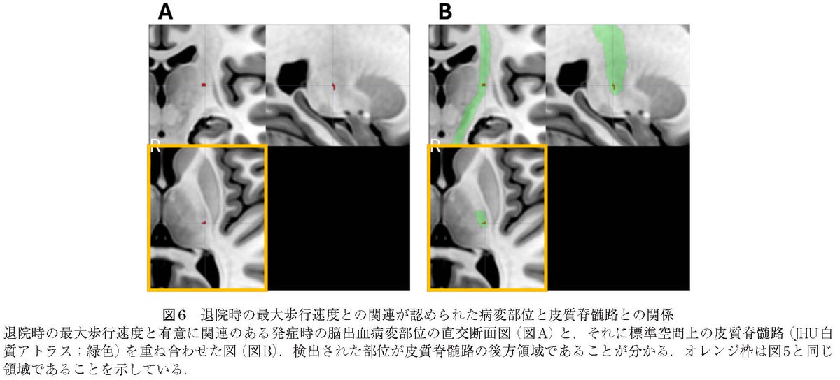 rigaku_journal's tweet photo. #理学療法学 53巻3号掲載の論文が早期公開されました

研究論文（原著）- CT画像の空間的標準化法を用いた脳画像解析

https://t.co/z8loWpOze1  

#Voxel_BasedLesion_SymptomMapping #脳卒中 #歩行速度 #回復期リハビリテーション病棟 https://t.co/P7x9SGgta5