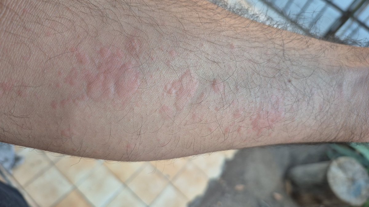 BlackRippersX's tweet photo. Yupi casi me voy al patio de los callados njajajajaj y eso no no saque una foto donde tenia los dos brazos llenos llenos y todos rojos... ahora la pregunta que alergia me dio y yo nunca me e enterado... tocara hacerce un examen antialergico para descubrirlo https://t.co/Rbaa7joViC