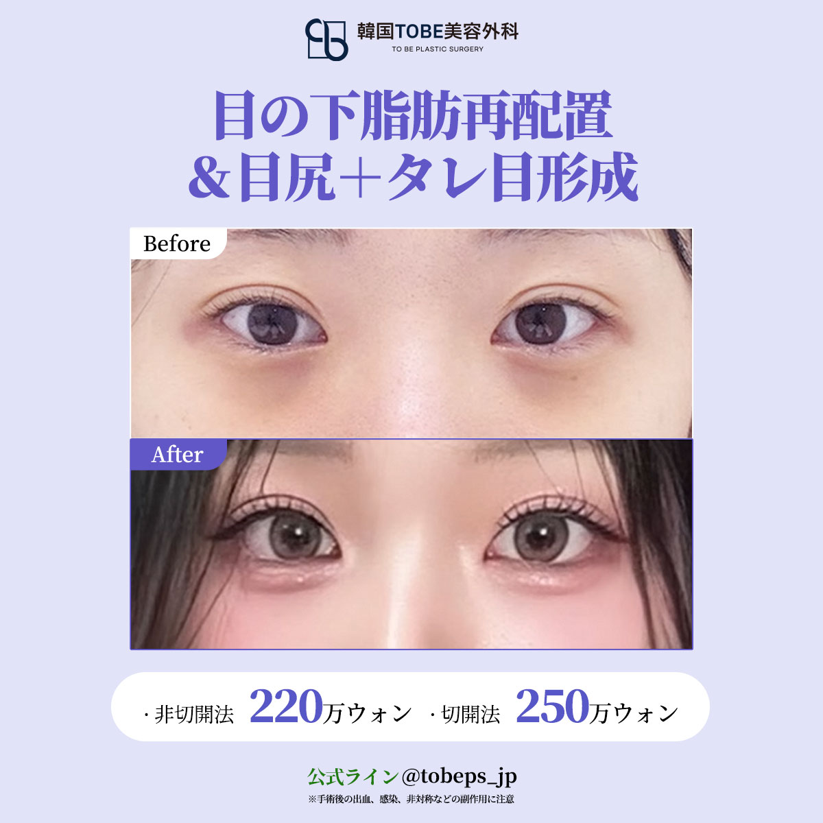 韓国TOBE美容外科 〚 二重・目元整形・目の下脂肪再配置〛 tweet media