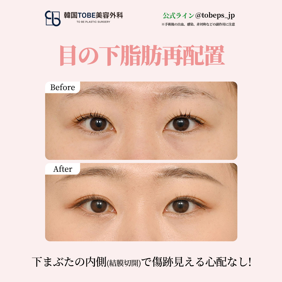 韓国TOBE美容外科 〚 二重・目元整形・目の下脂肪再配置〛 tweet media