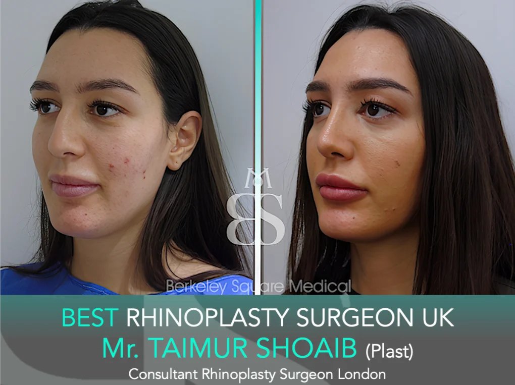 BerkeleySqMed's tweet photo. Balanced Facial Harmony with Natural Refinement
32-Year-Old Female Rhinoplasty | Tip Refinement & De-Projection by Mr. Taimur Shoaib

A sincere thank you to our patient for allowing us to share her results to help educate others considering rhinoplasty.

Our Patient’s Journey:
At 32, she felt her nose appeared slightly disproportionate to her facial features, particularly from the side profile. She wanted a refined and natural result that would improve balance without changing her identity. After consultation, she chose Berkeley Square Medical for a subtle and harmonious outcome.

Aim:
Rhinoplasty was performed to refine the nasal tip, straighten the profile, reduce projection, and correct the deviated septum to improve overall facial harmony.

Results Achieved:
✔️ Deviated Septum Corrected
✔️ Mild Tip Reduction
✔️ Straighter Side Profile
✔️ Columella / Tip Angle Corrected
Surgery performed by Mr. Taimur Shoaib @ Berkeley Square Medical.

📍 Berkeley Square Medical | London
https://t.co/6RtmEGmCKz

#Rhinoplasty #RhinoplastyLondon #RhinoplastyBeforeAndAfter #NoseJobUK #BerkeleySquareMedical #rhinoplastysurgeon #RhinoplastyUK #NoseJobLondon #rhinoplastyuk #nosejobuk #bestrhinoplastysurgeonuk