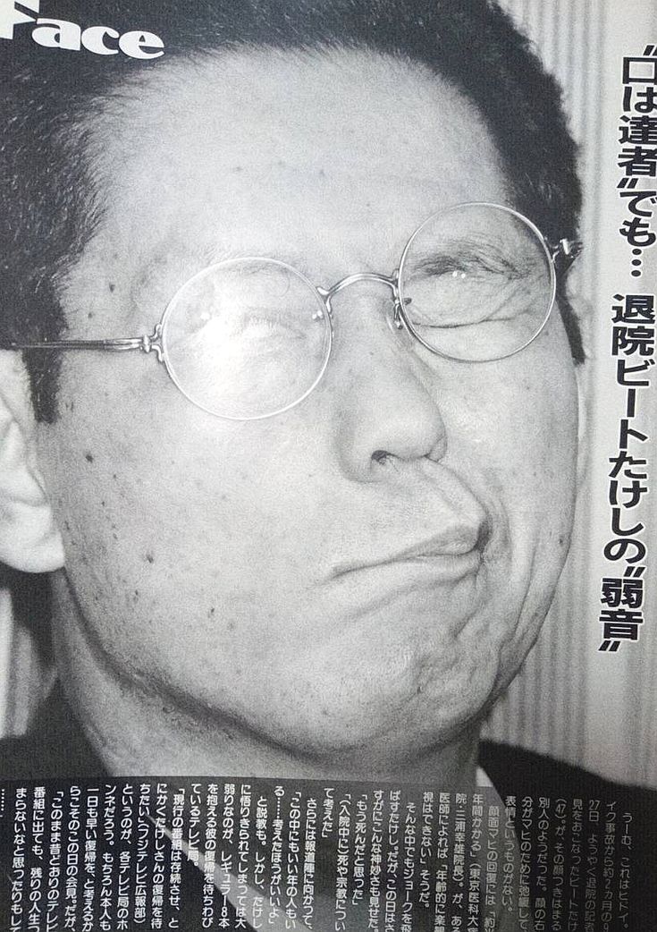 max358japan's tweet photo. 1994年8月2日午前1時40分ごろ、東京都新宿区の安鎮坂付近をスクーターでガードレールに激突事故起こしたときのタケシ氏（当時47歳）･･･😂💦
「治らなかったら、芸名を顔面マヒナスターズにします😚」
顔面麻痺で口がひん曲がちゃったまま退院とかでもそれを隠しもしないでお笑いに転嫁しちゃう天才芸能人でしたね🤣