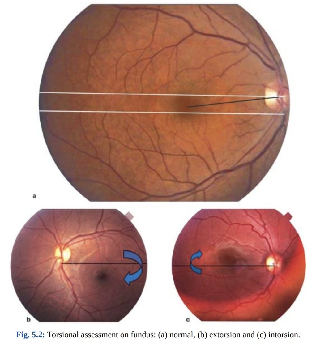 ODath33's tweet photo. أغرب معلومة قريتها هالفترة إن دوران العين يظهر بالشبكية (excycloduction), (incycloduction) 👁️
 حيث يتغير موقع العصب البصري بالنسبة لمركز الإبصار https://t.co/Sd3lzBVe98