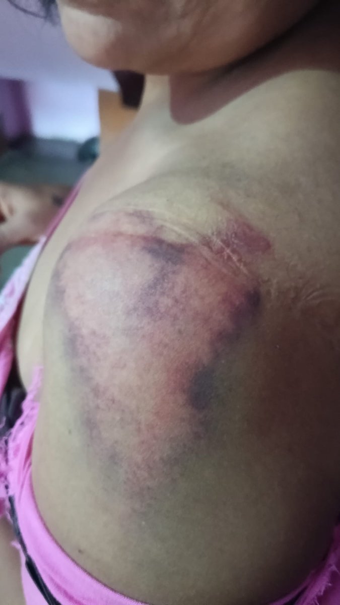 ANURAGNMP's tweet photo. @unnaopolice ये चोट के बाद @unnaopolice चालान कर रही जब की मुकदमा बन रहा है दबंग मुस्लिम को थाने की संरक्षण प्राप्त है 
@Uppolice https://t.co/ubnM6swTBC