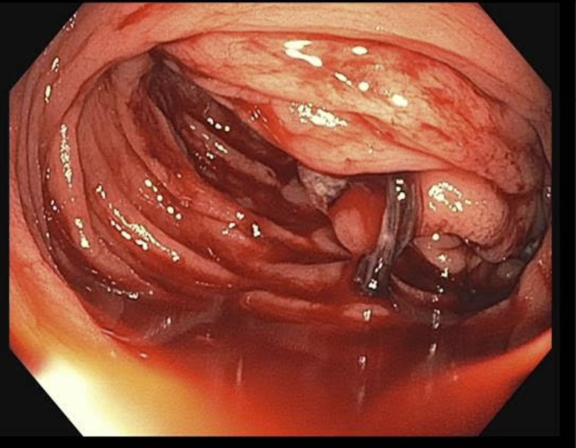EndoCollab™ | GI Endoscopy Community tweet media