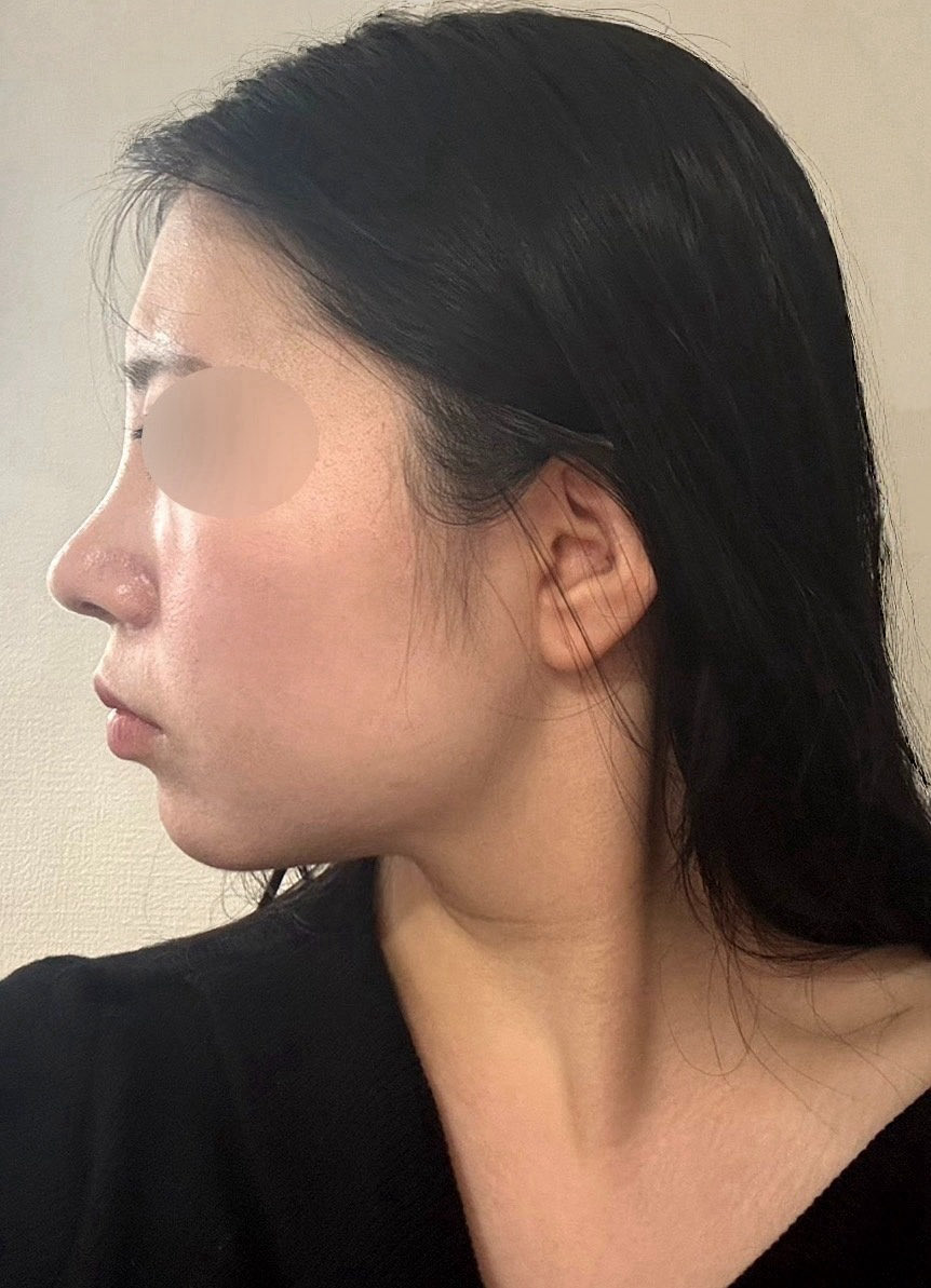 くるる *⋆✈︎8月中に輪郭3点・脂肪吸引/鼻DT中 tweet media