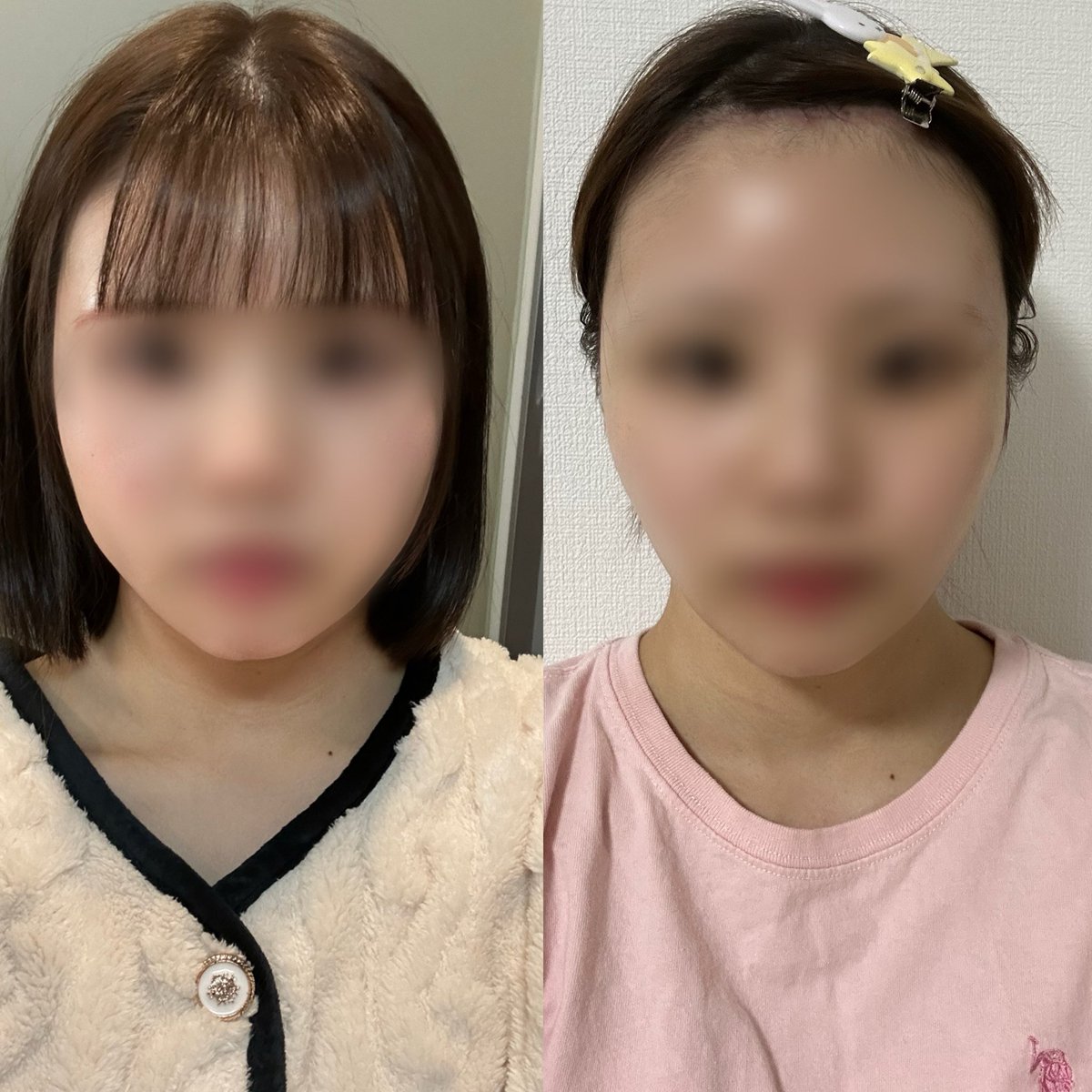 mopemope0000's tweet photo. プリンス整形外科でミニ切開リフト、バッカルファット除去、頬脂肪吸引
3ヶ月経ちました~🌟⋆꙳

正面から写真見るとだいぶ印象変わったな…
最初は脂肪吸引ウーンって思ってたけど
経過でだいぶ馴染んだかも🤍

私は頬骨斜めに出てる方だからリフトアップで頬骨目立っちゃうけど
さほど気にならない！ https://t.co/k4dnG5om3V