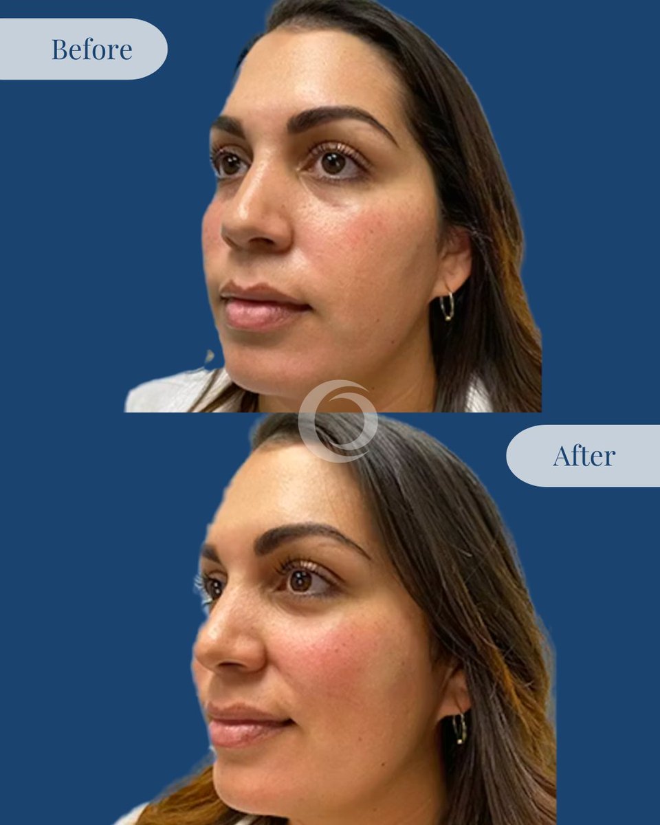 Enhancing cheeks isn’t just about volume. 💉✨ It’s about balance, structure, and harmony. These before-and-after results show how expertly placed facial filler can subtly lift and contour the midface, restore youthful shape, and beautifully complement your natural features.