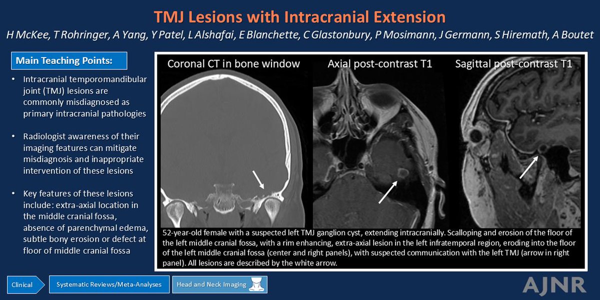 TheAJNR's tweet photo. "Temporomandibular Joint Lesions with Intracranial Extension: Illustrative Cases from a Systematic Review of the Literature and Our Institution"

https://t.co/YupbYklulL

@HayleyAMcKee https://t.co/ZS9Zp8yZeF