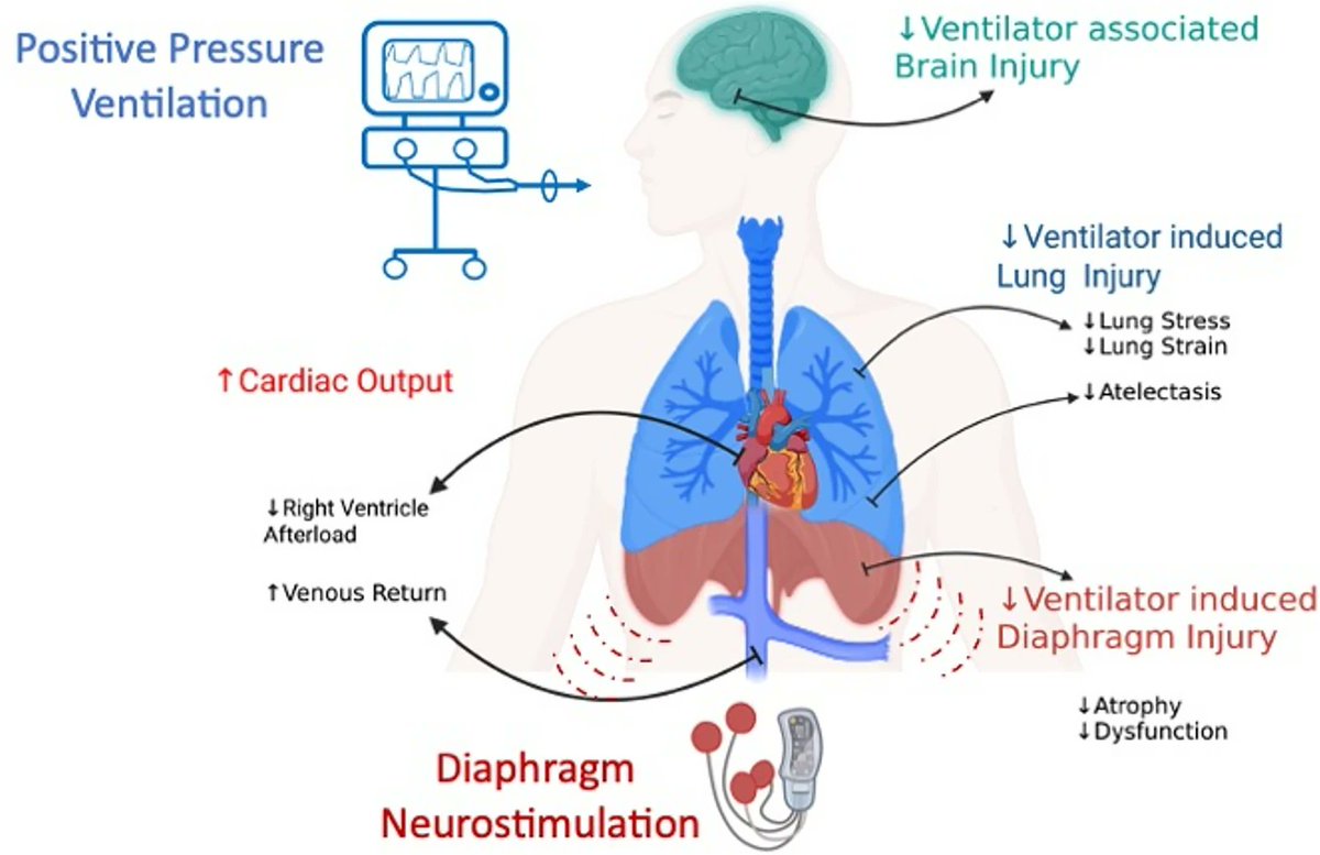 CritCareReviews's tweet photo. The emerging role of diaphragm neurostimulation in ARDS

CCR Journal Watch
https://t.co/Sp06oA6IDG https://t.co/tcHlDhKXiw