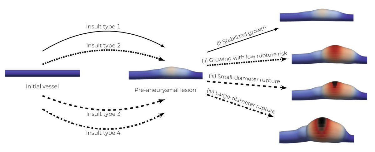 schwarzish's tweet photo. Excited to share our newly published work showing how vascular insults contribute to simulate distinct aneurysm phenotypes (with future applications in patient-specific risk prediction) Check it out here: https://t.co/BcPtypxwsf

#biomechanics #mechanobiology https://t.co/6j4LUCMmv1