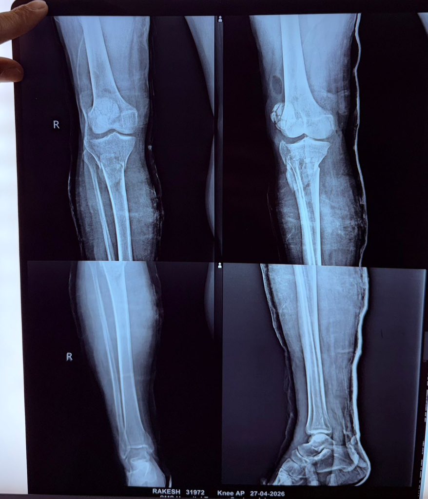 suburb_monk's tweet photo. “One limb. Multiple fractures.
Proximal tibia ORIF with plate & screws.
Comminuted patella stabilized with percutaneous encirclage.
Pott’s ankle fixed with plate + CC screws.
Long OT day… still made it for chest workout 💪⚡️”
#Orthopaedics #TraumaSurgery #ORIF #TibiaFracture #PatellaFracture #AnkleFracture #OrthoResident #SurgeryLife #GymAfterDuty #ResidentLife