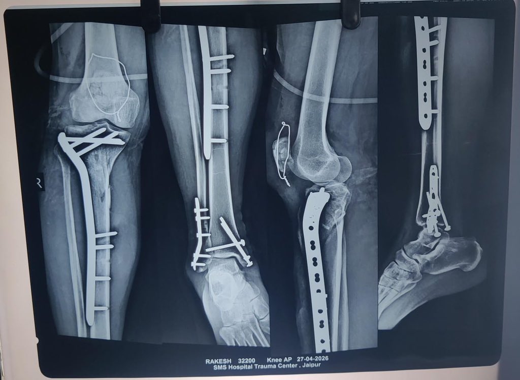 suburb_monk's tweet photo. “One limb. Multiple fractures.
Proximal tibia ORIF with plate & screws.
Comminuted patella stabilized with percutaneous encirclage.
Pott’s ankle fixed with plate + CC screws.
Long OT day… still made it for chest workout 💪⚡️”
#Orthopaedics #TraumaSurgery #ORIF #TibiaFracture #PatellaFracture #AnkleFracture #OrthoResident #SurgeryLife #GymAfterDuty #ResidentLife