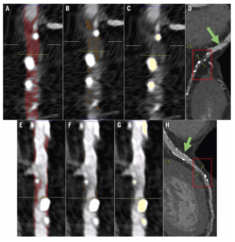 EuroInterventio's tweet photo. A DCB-only strategy for de novo coronary CTOs may promote favourable plaque redistribution and stabilisation over time.
In 3 serial CCTA cases using conventional CT and photon-counting CT, residual stenosis remained <40% at follow-up, with reductions in plaque burden and remodelling index after paclitaxel-eluting balloon PCI. #CardioTwitter #PCI #DCB #CCTA 

https://t.co/CslS9mqseQ 

@MDobrolinska @damini_dey @OpolskiMP