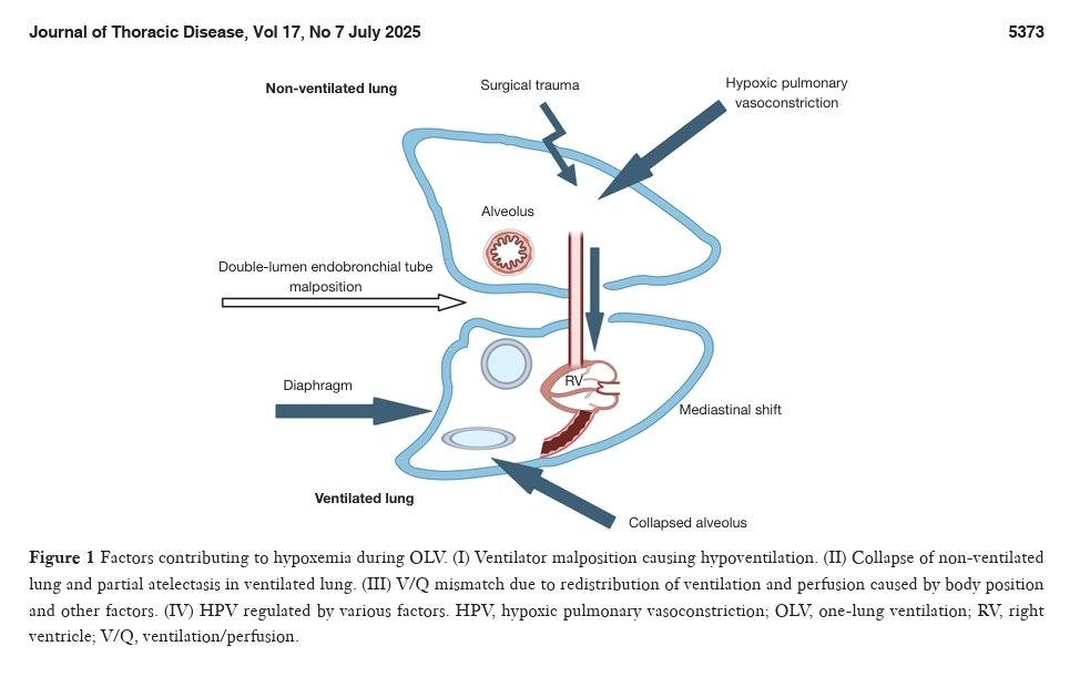 AnestesiologiaR's tweet photo. Enfoques personalizados de ventilación unipulmonar y resultados pulmonares postoperatorios en cirugia torácica.
J Thorac Dis 2025;17(7):5371-5387.
doi: 10.21037/jtd-2025-314.
#ventilation #lung #anesthesia #surgery #intubation #airway #anesthesiology https://t.co/75B7kOl5ha
