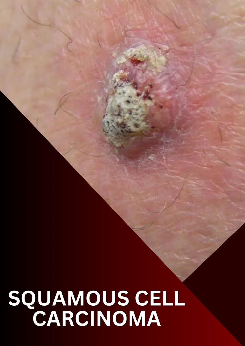 PRSC_SCMC's tweet photo. Texture matters. If it's scaly, crusty, or firm, get it checked! 🤨🔍

Squamous Cell Carcinoma (SCC) is the second most common skin cancer, but when caught early, it’s highly treatable. Don't ignore a spot that won't heal 🚩

#PRSC_infographic
#SkinCancerAwarenessMonth https://t.co/Pezqf1eWns